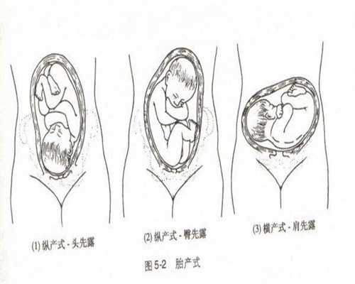 深圳助孕:怎样鉴别试管婴儿