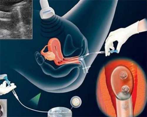 国内代孕几种方式:多囊卵巢综合症的症状预警