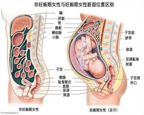 上海代孕生子能成功吗:子宫内膜异位症会不会导
